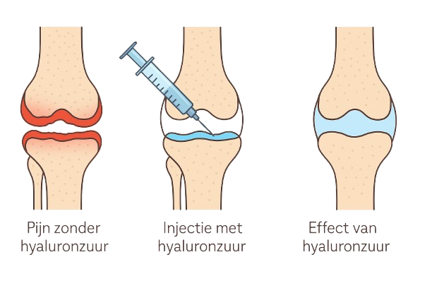 Illustratie van de werking van een hyaluronzuurinjectie in de knie: van pijnlijke knie zonder injectie, via injectiemoment, tot verlichting van pijn.