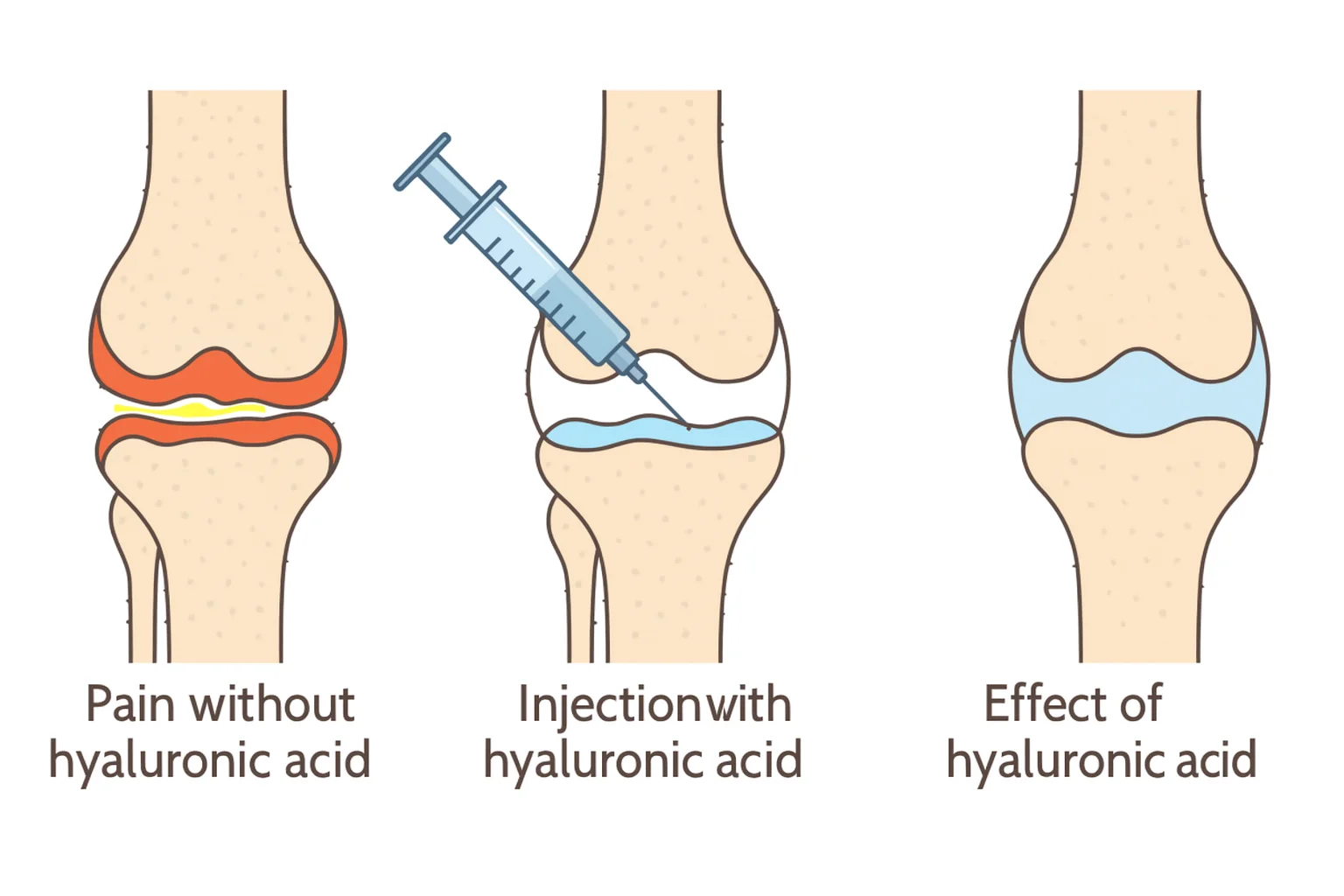 Medical illustration showing the effect of hyaluronic acid injection in the knee: painful joint without treatment, injection process, and pain relief with improved joint lubrication.