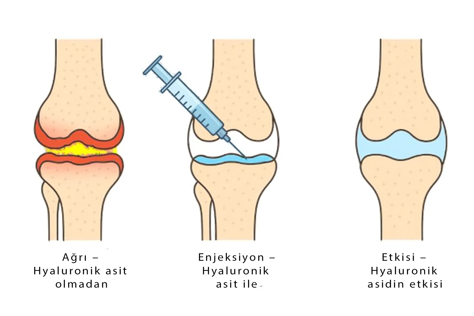 Üç aşamalı illüstrasyon: hyaluronik asit olmadan dizde ağrı, hyaluronik asit enjeksiyonu ve enjeksiyon sonrası eklemde hyaluronik asidin olumlu etkisi.