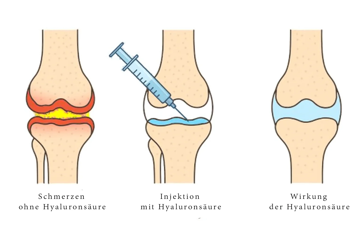 Medizinische Illustration, die die Wirkung einer Hyaluronsäure-Injektion im Knie zeigt: schmerzhaftes Gelenk ohne Behandlung, Injektionsvorgang und Schmerzlinderung durch verbesserte Gelenkschmierung.