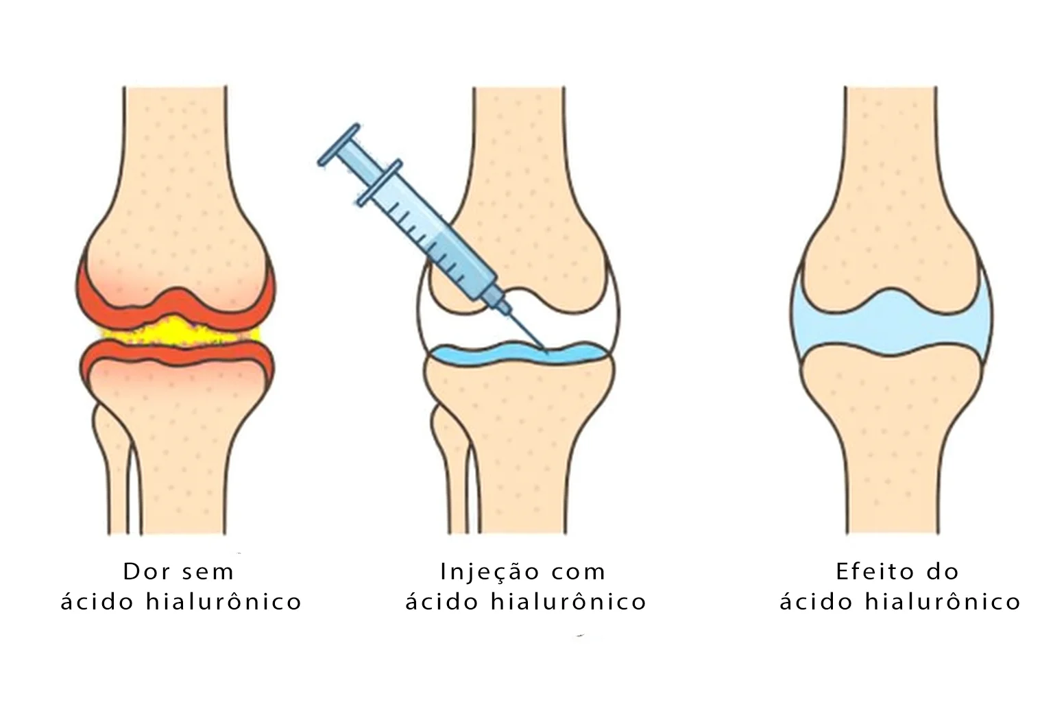 Ilustração médica mostrando o efeito da injeção de ácido hialurônico no joelho: articulação dolorida sem tratamento, processo de injeção e alívio da dor com melhor lubrificação articular.