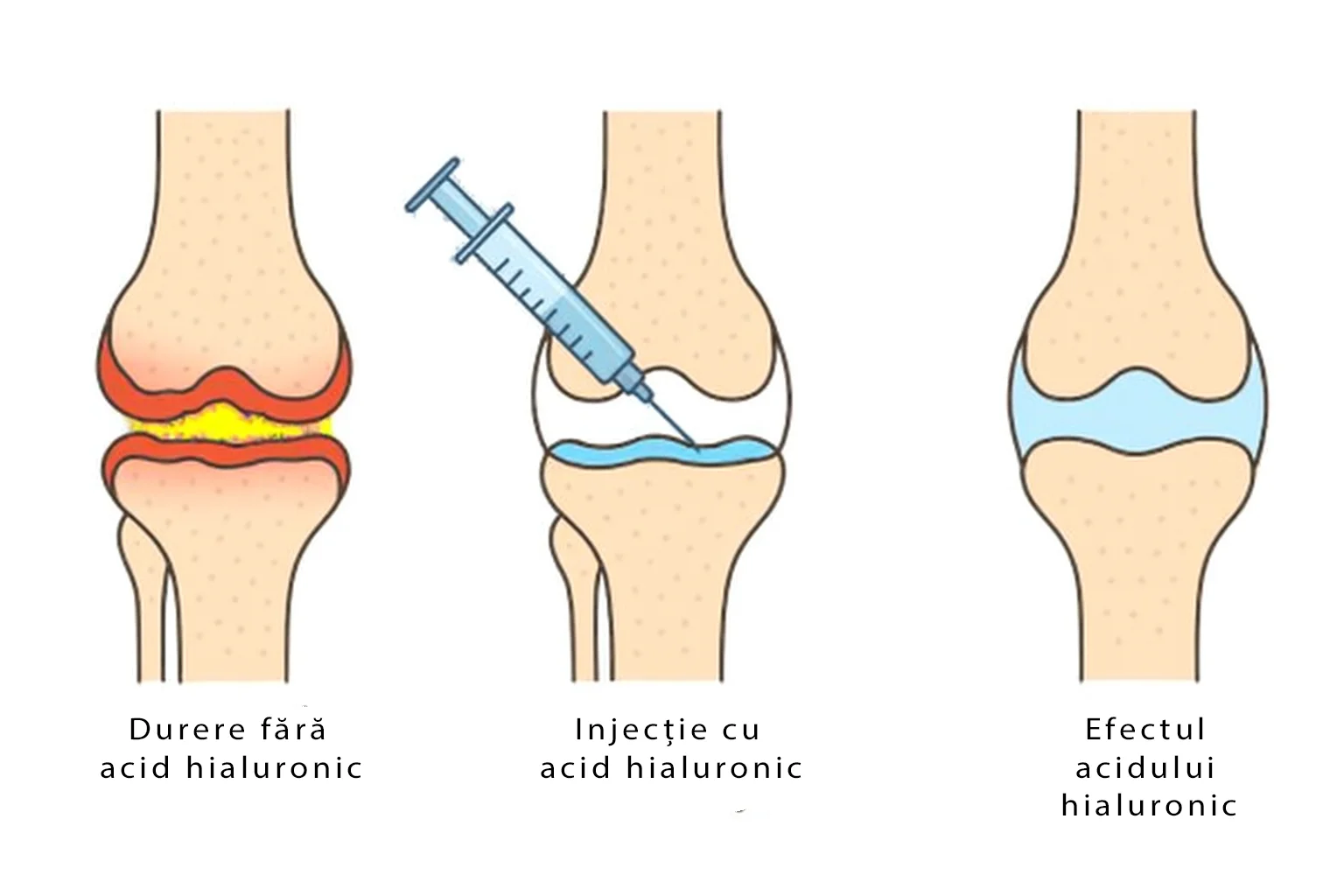 Ilustrație medicală care arată efectul injecției cu acid hialuronic în genunchi: articulație dureroasă fără tratament, procesul de injectare și ameliorarea durerii prin lubrifiere îmbunătățită a articulației.