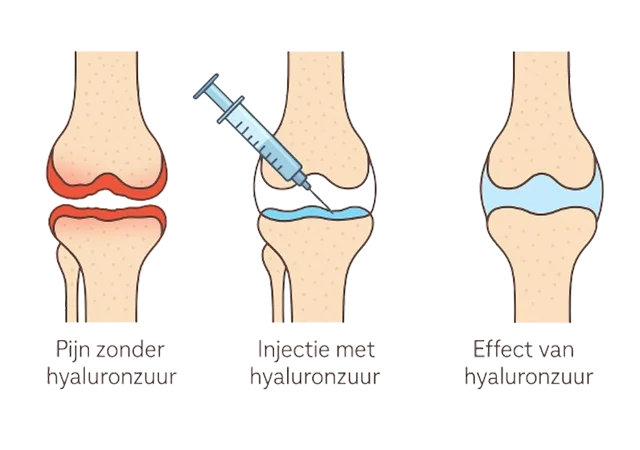 Illustratie van de werking van een hyaluronzuur injectie in de knie: van pijnlijke knie zonder injectie, via hyaluronzuur behandeling, tot verlichting van pijn.