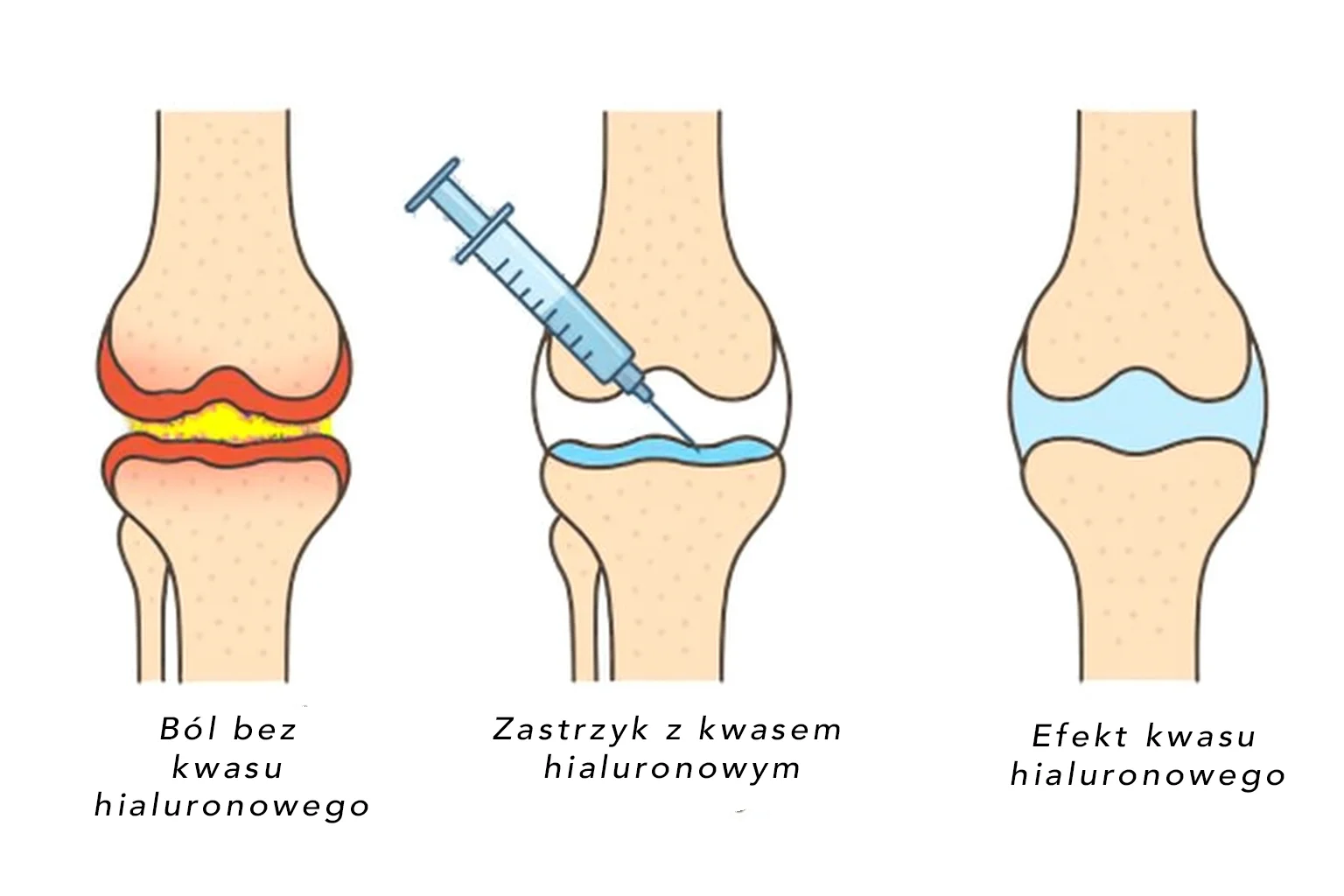 Ilustracja w trzech etapach: ból kolana bez kwasu hialuronowego, iniekcja dostawowa z kwasem hialuronowym oraz efekt poprawy po podaniu zastrzyku.