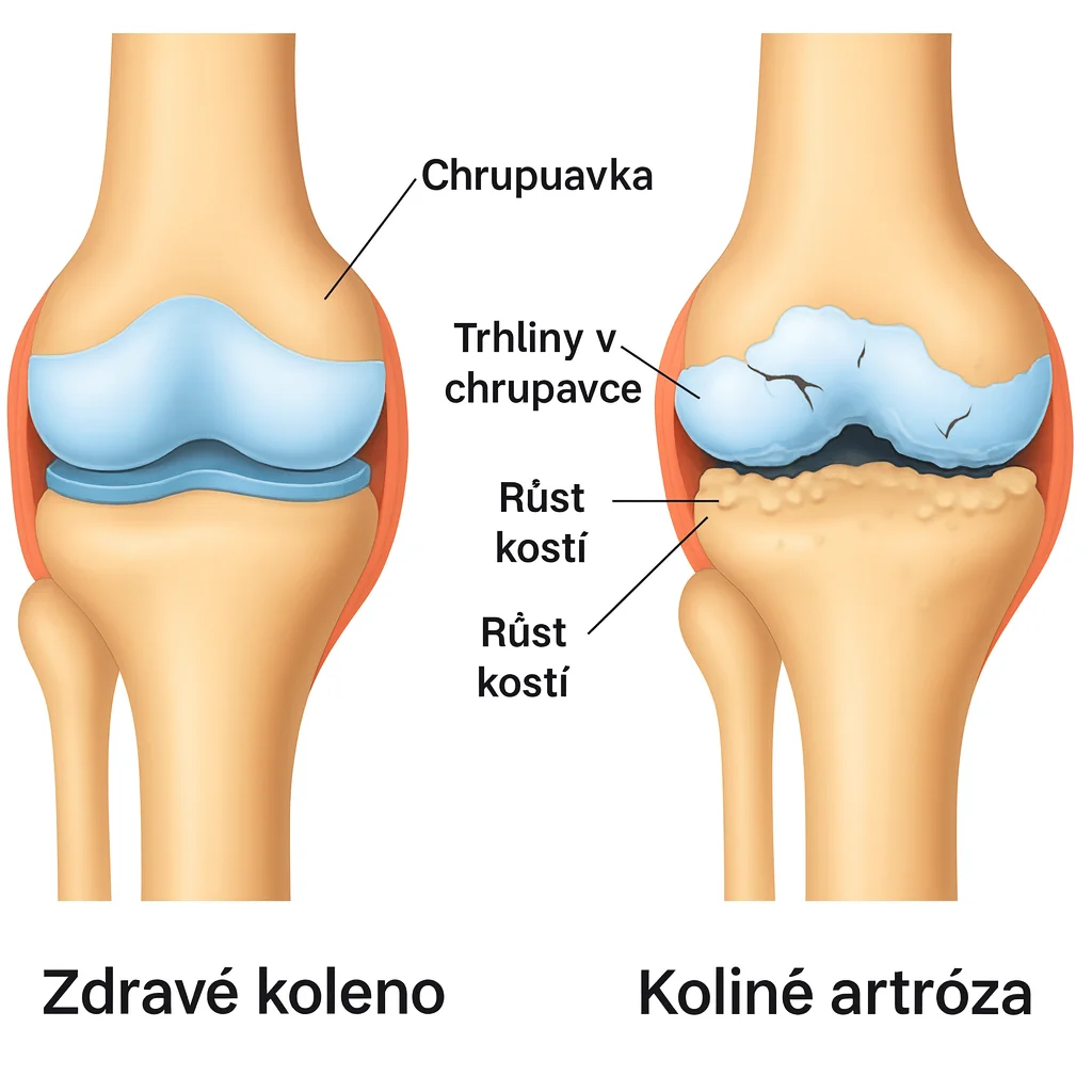 Srovnání zdravého kolene a kolene s artrózou. Zdravé koleno má hladkou chrupavku a kloubní tekutinu. Při artróze jsou patrné trhliny v chrupavce a růst kostí.