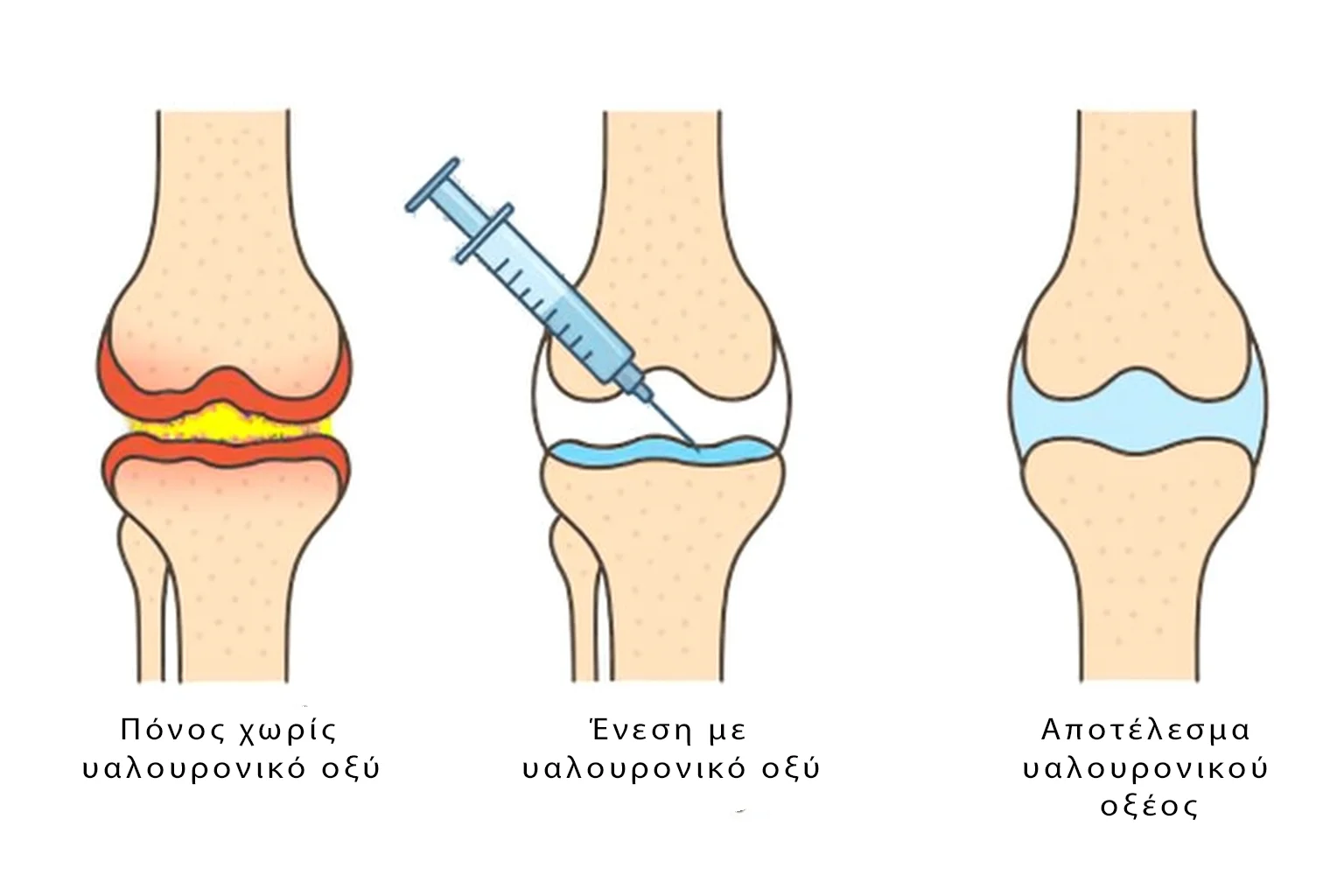 Ιατρική απεικόνιση που δείχνει: επώδυνη άρθρωση χωρίς θεραπεία, διαδικασία ένεσης και ανακούφιση πόνου με βελτιωμένη λίπανση της άρθρωσης.