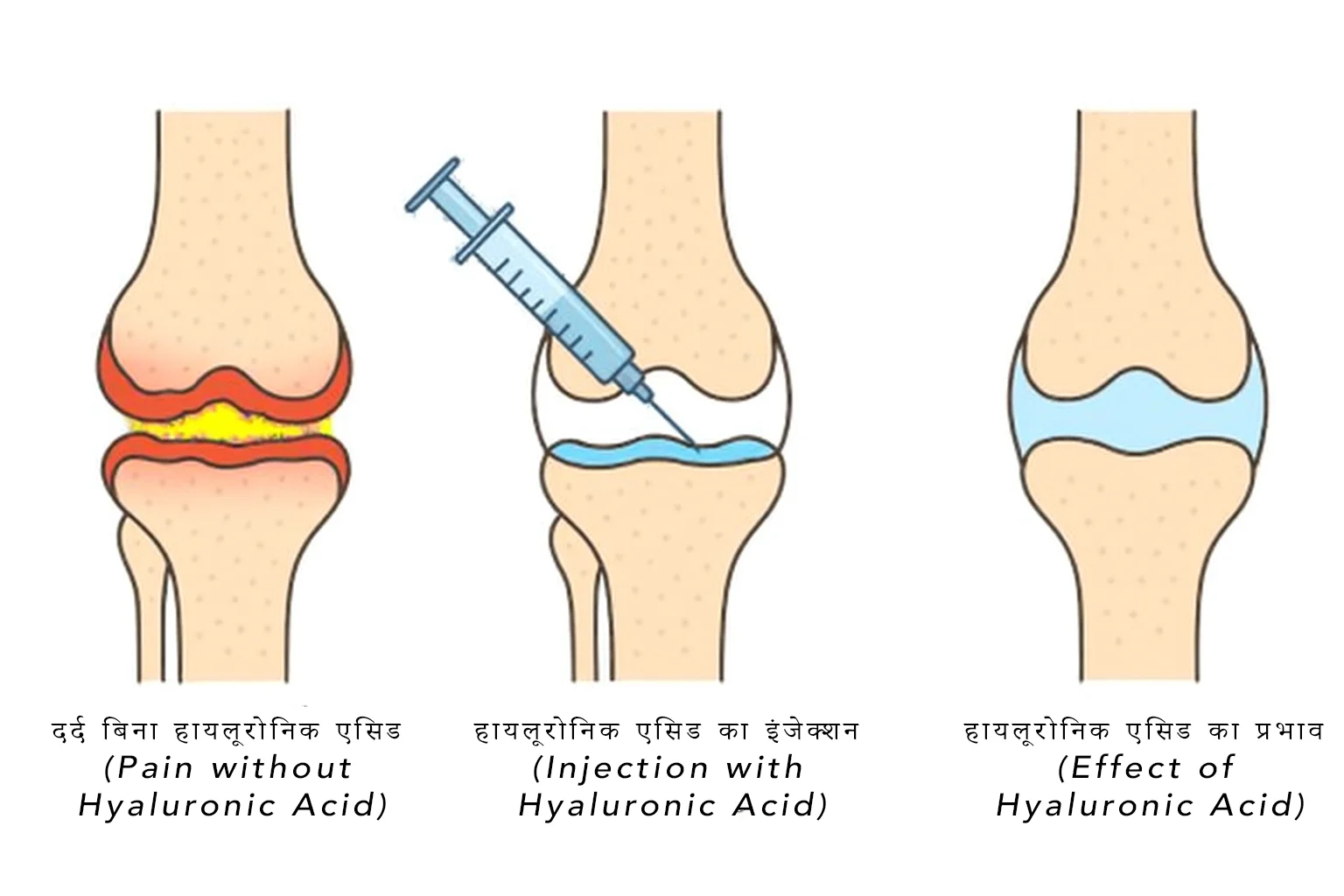 चिकित्सा चित्रण (Medical illustration) जो घुटने में हायलूरोनिक एसिड इंजेक्शन का प्रभाव दिखाता है: बिना उपचार वाला दर्दयुक्त जोड़ (Painful joint without treatment), इंजेक्शन प्रक्रिया (Injection process), और उपचार के बाद बेहतर लुब्रिकेशन (Improved joint lubrication) के साथ दर्द में राहत (Pain relief)।
