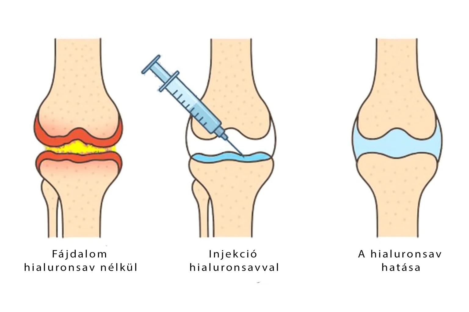 Orvosi illusztráció, amely bemutatja a hialuronsav injekció hatását a térdben: fájdalmas ízület kezelés nélkül, az injekció beadása, valamint a fájdalomcsillapítás és a javított ízületi kenés.