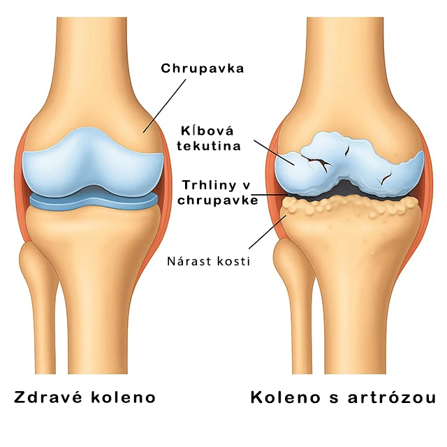 Zdravé koleno a koleno s artrózou – porovnanie stavu kĺbu