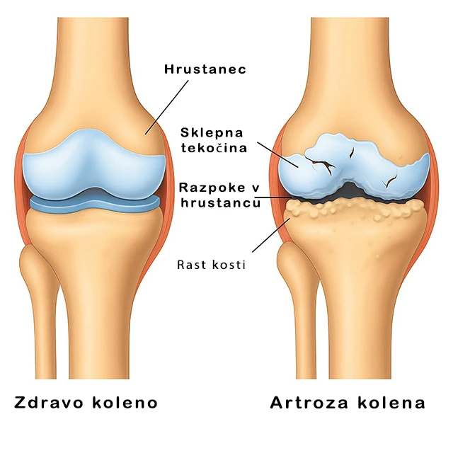 Ilustracija zdravega kolena in kolena z artrozo – hrustanec, sklepna tekočina, razpoke v hrustancu in kostni izrastki